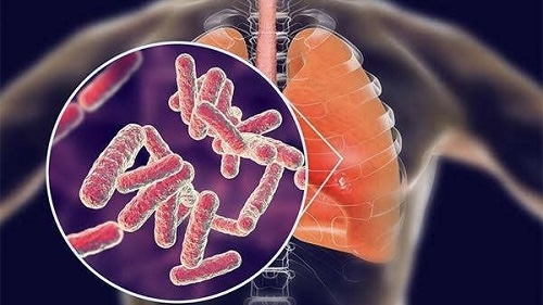 Kasus TB Papua 4 Persen Nasional, Pemerintah Soroti Rendahnya Deteksi